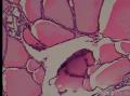 甲状腺乳头状癌？图18