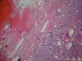 甲状腺腺瘤。图13