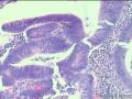 阑尾 管状腺瘤 高级别？图10