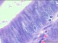 阑尾 管状腺瘤 高级别？图12