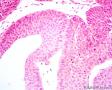 膀胱肿瘤（低级别乳头状尿路上皮癌？），求助老师图10