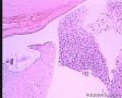 乳腺肿块，术中冰冻没敢报癌，老师们请发表高见。图2