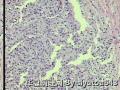 右腋窝包块   皮肤附属器肿瘤  汗腺瘤？！图1