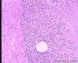 乳腺肿块，术中冰冻没敢报癌，老师们请发表高见。图5