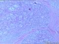 发现右侧腋窝无痛性包块2年，性质待定图3
