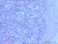 发现右侧腋窝无痛性包块2年，性质待定图17