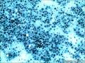 病例分享：腹水标本（胃印戒细胞癌转移）图10