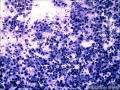 病例分享：腹水标本（胃印戒细胞癌转移）图1