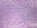 右侧腋窝肿物图21