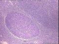 右侧腋窝肿物图15