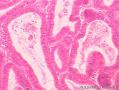 子宫内膜腺瘤样息肉吗？谢谢。图4