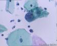 考虑LSIL——活检结果出来了，大家再瞅瞅有没有CIN2（活检结果见18-20楼）图12