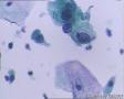 考虑LSIL——活检结果出来了，大家再瞅瞅有没有CIN2（活检结果见18-20楼）图23