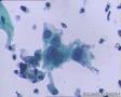 考虑LSIL——活检结果出来了，大家再瞅瞅有没有CIN2（活检结果见18-20楼）图14