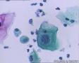 考虑LSIL——活检结果出来了，大家再瞅瞅有没有CIN2（活检结果见18-20楼）图13
