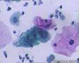 考虑LSIL——活检结果出来了，大家再瞅瞅有没有CIN2（活检结果见18-20楼）图1