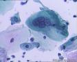 考虑LSIL——活检结果出来了，大家再瞅瞅有没有CIN2（活检结果见18-20楼）图24