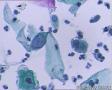 考虑LSIL——活检结果出来了，大家再瞅瞅有没有CIN2（活检结果见18-20楼）图28