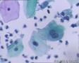 考虑LSIL——活检结果出来了，大家再瞅瞅有没有CIN2（活检结果见18-20楼）图8