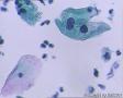 考虑LSIL——活检结果出来了，大家再瞅瞅有没有CIN2（活检结果见18-20楼）图20