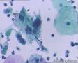 考虑LSIL——活检结果出来了，大家再瞅瞅有没有CIN2（活检结果见18-20楼）图22