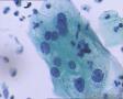 考虑LSIL——活检结果出来了，大家再瞅瞅有没有CIN2（活检结果见18-20楼）图11