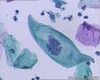考虑LSIL——活检结果出来了，大家再瞅瞅有没有CIN2（活检结果见18-20楼）图7