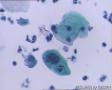 考虑LSIL——活检结果出来了，大家再瞅瞅有没有CIN2（活检结果见18-20楼）图27