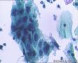 考虑LSIL——活检结果出来了，大家再瞅瞅有没有CIN2（活检结果见18-20楼）图25