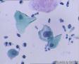 考虑LSIL——活检结果出来了，大家再瞅瞅有没有CIN2（活检结果见18-20楼）图21