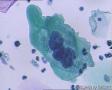 考虑LSIL——活检结果出来了，大家再瞅瞅有没有CIN2（活检结果见18-20楼）图18