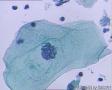 考虑LSIL——活检结果出来了，大家再瞅瞅有没有CIN2（活检结果见18-20楼）图16
