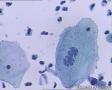考虑LSIL——活检结果出来了，大家再瞅瞅有没有CIN2（活检结果见18-20楼）图4