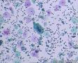 考虑LSIL——活检结果出来了，大家再瞅瞅有没有CIN2（活检结果见18-20楼）图17