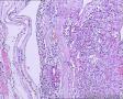 甲状腺包块请教诊断图12