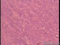 管状腺瘤还是纤维腺瘤？图3