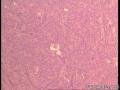 管状腺瘤还是纤维腺瘤？图4