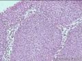 宫颈活检CIN3累腺？图16