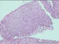宫颈活检CIN3累腺？图14