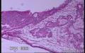 左侧卵巢肿瘤(增加常规图片)图28