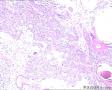 女，腭部肿块，临床考虑腭癌，海量图片，请指导图1