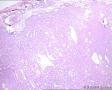女，腭部肿块，临床考虑腭癌，海量图片，请指导图4