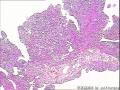 请教！膀胱新生物。图1