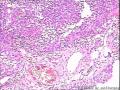 请教！膀胱新生物。图6