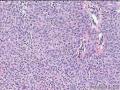 汗孔瘤？？？图10