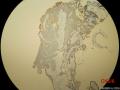 左耳鼓室内新生物图19
