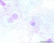 女，85岁，尿液，临床考虑膀胱结核图7