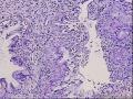 这个宫颈是鳞化，还是累腺图4