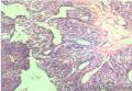 头皮肿物图4