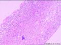 右侧腰大肌肿块穿刺活检组织，怎么考虑？图6
